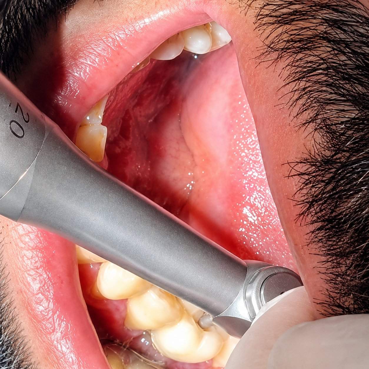 Dental Digital Torque Implant Driver